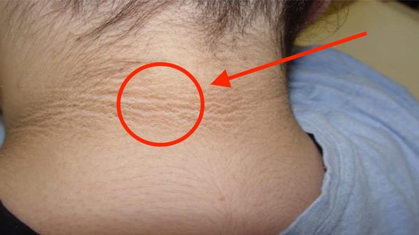 Acanthosis Nigricans - Hình ảnh minh họa